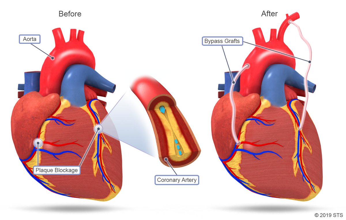 Coronary artery bypass surgeries