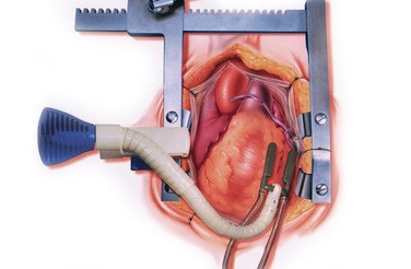 Expansion of cardiac stabilizers function